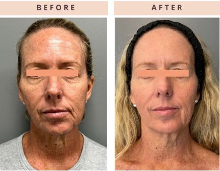 Everesse Before and After 