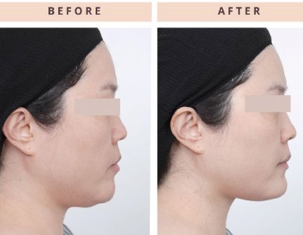 Everesse Before and After 